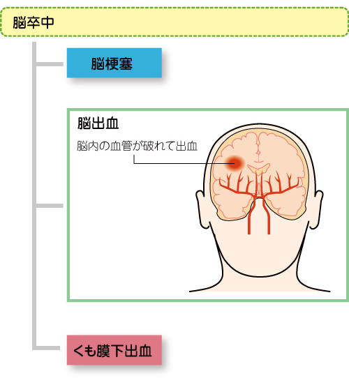 は 脳幹 出血 と