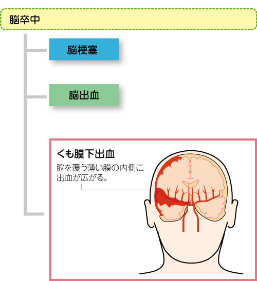 くも膜下出血