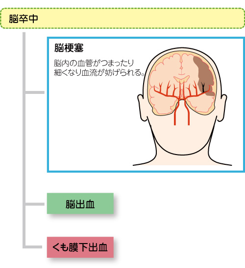 脳梗塞