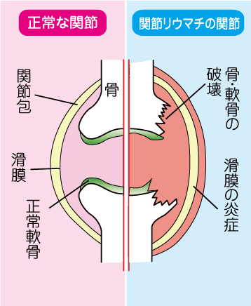 正常な関節と関節リウマチの関節