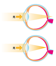 ＜遠視＞屈折異常