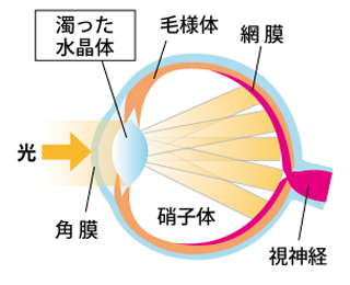 白内障の目の断面図